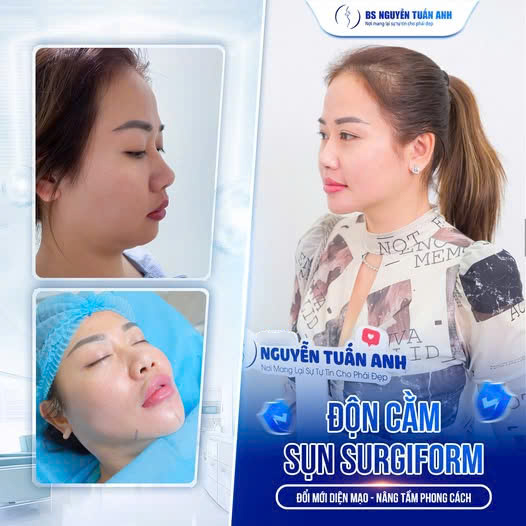 Độn cằm sụn surgiform