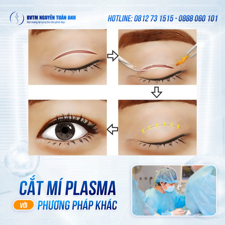 Cắt mí Plasma có thật sự tốt hơn phương pháp khác?