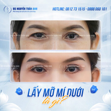 Lấy Mỡ Mí Dưới Có Làm Vùng Mắt Sáng Hơn Không?