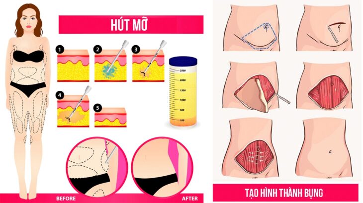 Tạo hình thành bụng khác gì hút mỡ bụng? Tạo hình thành bụng khác gì hút mỡ bụng?