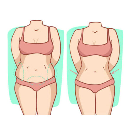 Hút mỡ bị lồi lõm có chỉnh sửa được không? Hút mỡ bị lồi lõm có chỉnh sửa được không?